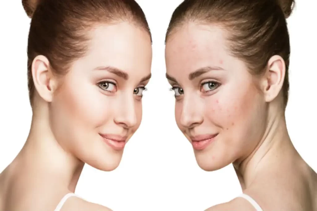 Acne with Cosmeceuticals Skin Care