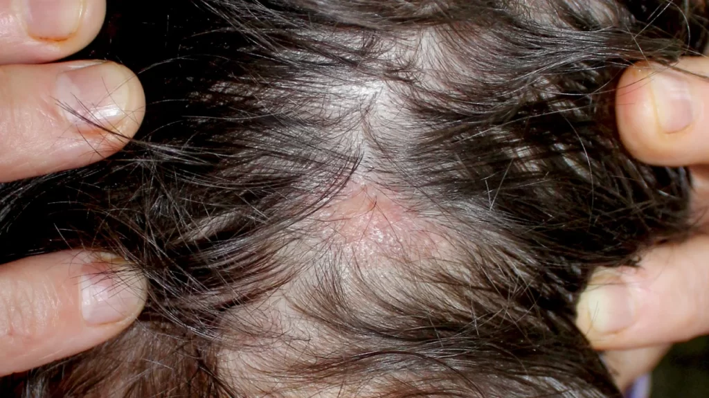 Hair Loss Problem